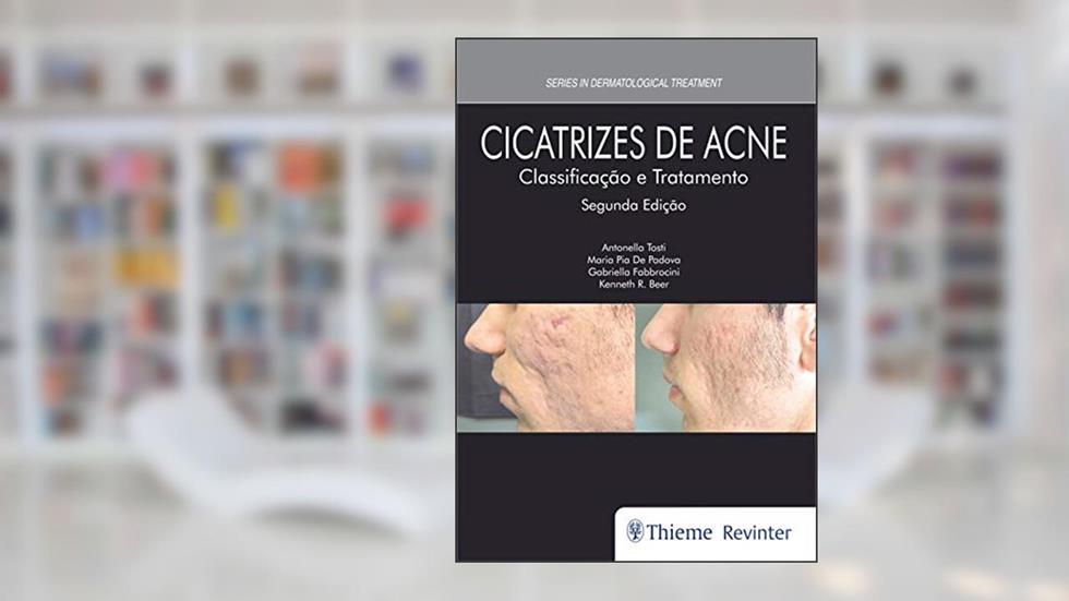 Cicatrizes de Acne: Classificação e Tratamento, do autor Antonella Tosti; Maria Pia de Padova; Gabriella Fabbrocini; Kenneth R. Beer