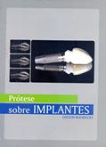 Ler Prótese Sobre Implantes, do autor Dalton Rodrigues