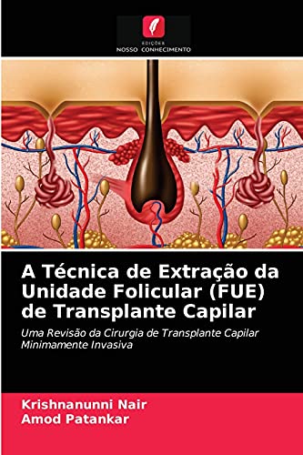 Ler A Técnica de Extração da Unidade Folicular (FUE) de Transplante Capilar: Uma Revisão da Cirurgia de Transplante Capilar Minimamente Invasiva, do autor Krishnanunni Nair; Amod Patankar