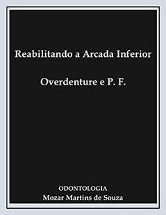Reabilitando a Arcada Inferior Overdenture e Prótese Fixa: Prótese Odontológica, do autor Mozar Martins