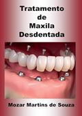 Ler Tratamento de Maxila Desdentada: Implantologia, do autor Mozar M de Souza