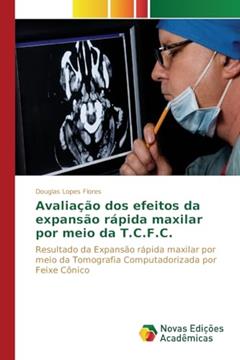 Avaliação dos efeitos da expansão rápida maxilar por meio da T.C.F.C.: Resultado da expansão rápida maxilar por meio da tomografia computadorizada por feixe cônico, do autor Lopes Flores Douglas