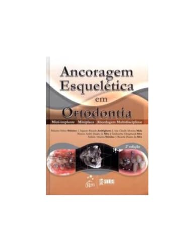 Ler Ancoragem Esquelética em Ortodontia - Mini-implante - Miniplaca - Abordagem Multidisciplinar, do autor Vários autores