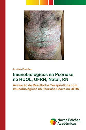 Ler Imunobiológicos na Psoríase no HUOL, UFRN, Natal, RN: Avaliação de Resultados Terapêuticos com Imunobiológicos na Psoríase Grave na UFRN, do autor Arnóbio Pachêco