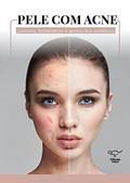 Ler Pele com acne: conceito, tratamento e protocolos estéticos, do autor Cristiane Ribeiro; Regina Gante Ler Pele com acne: conceito, tratamento e protocolos estéticos, do autor Cristiane Ribeiro; Regina Gante
