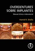 Ler Overdentures Sobre Implantes: Manual Clínico e Laboratorial, do autor Hamid R. Shafie